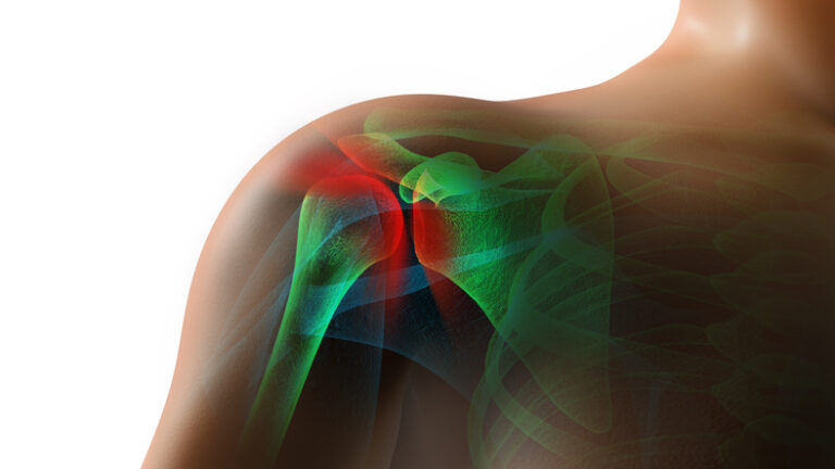 Rotator_Cuff_Credit_jqbaker_03_20_17_0